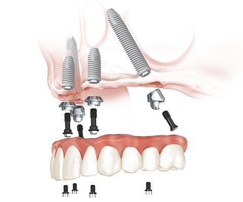 All on four dental implants - upper jaw