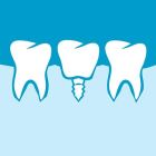 Dental Implants Costa Rica