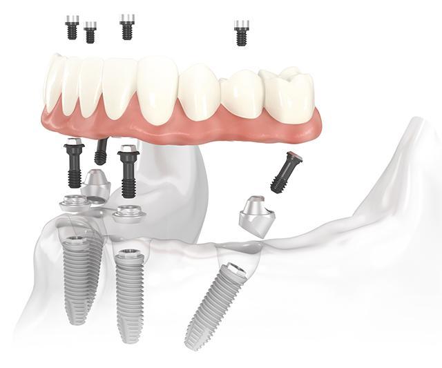 All-on-4 dental implants lower jaw