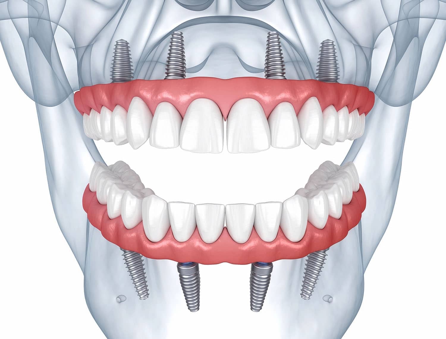All-on-4 full arch dental implants render