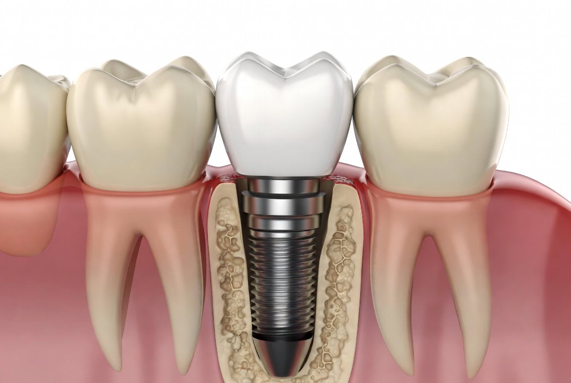 Dental implants