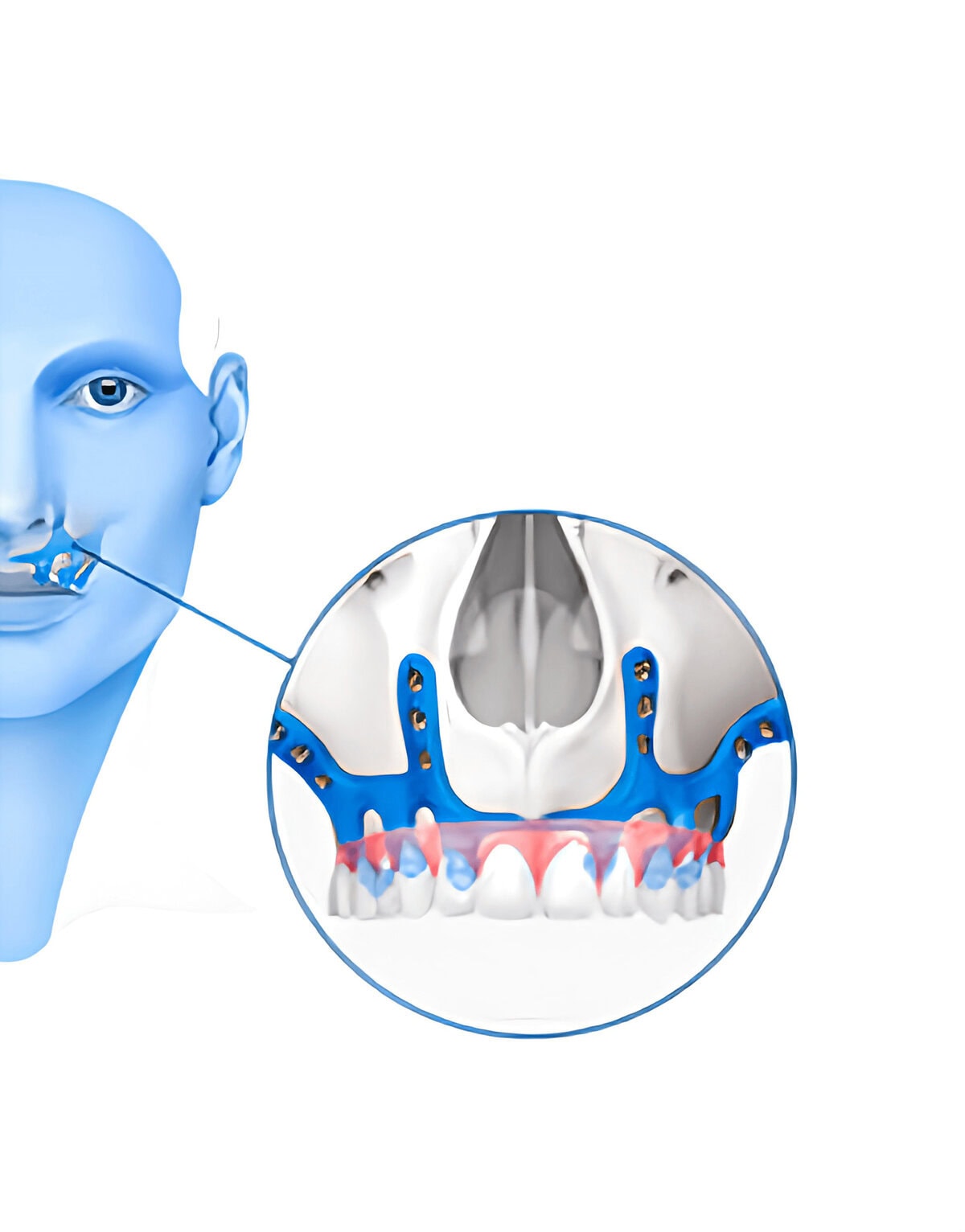 Subperiosteal implant titanium framework illustration