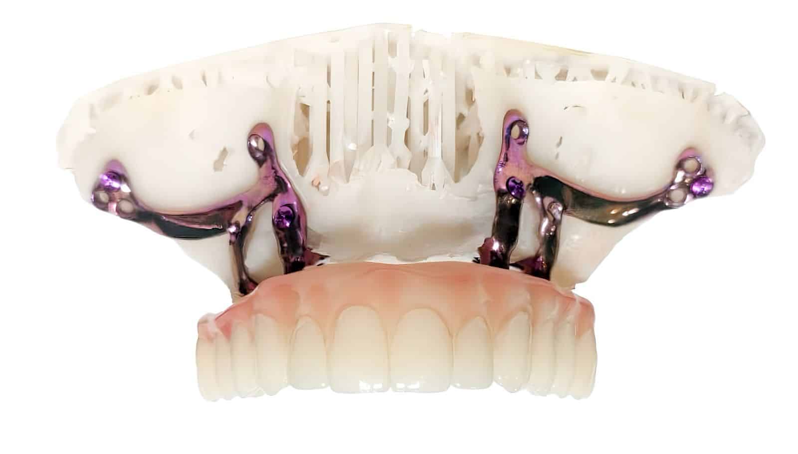 Real subperiosteal titanium implant printed in-house at New Smile