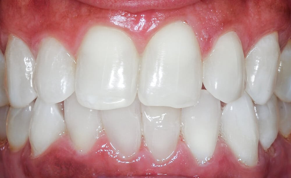 Teeth whitening after, real patient