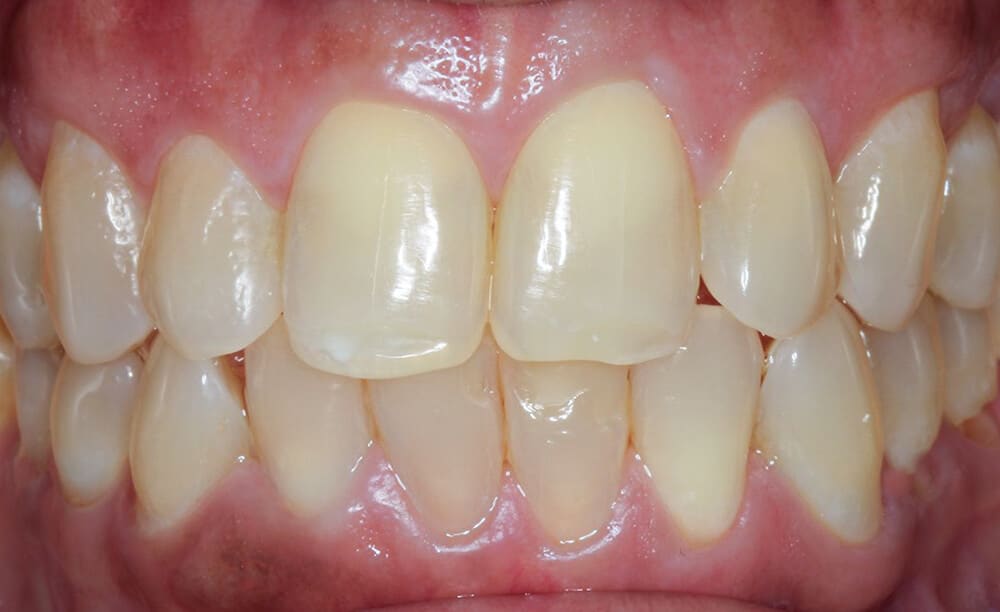 Teeth whitening before, real patient