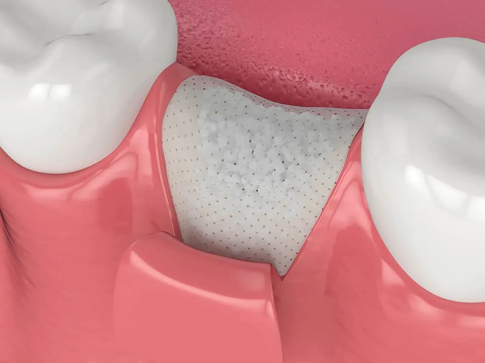 Dental bone graft placed in the jaw before an implant