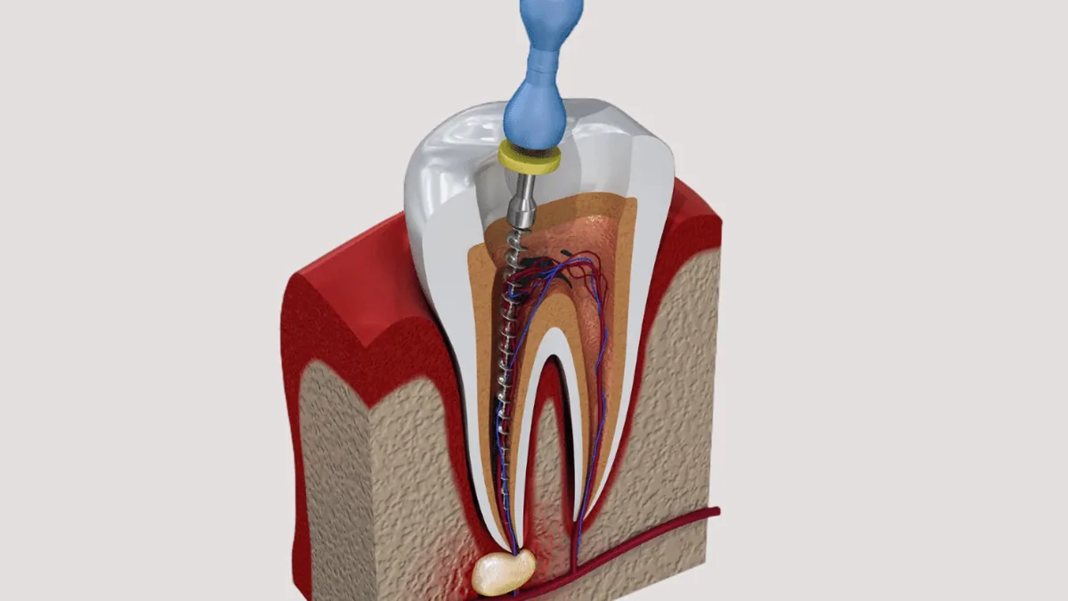 Root canal treatment shown in a tooth cross section